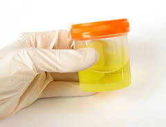 Test d'urine capable de détecter la borréliose de Lyme